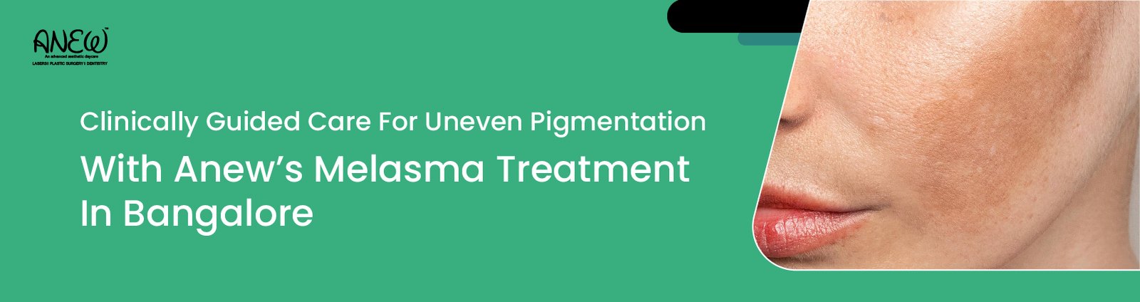  melasma treatment in bangalore